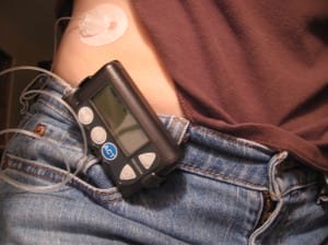 insulin pump